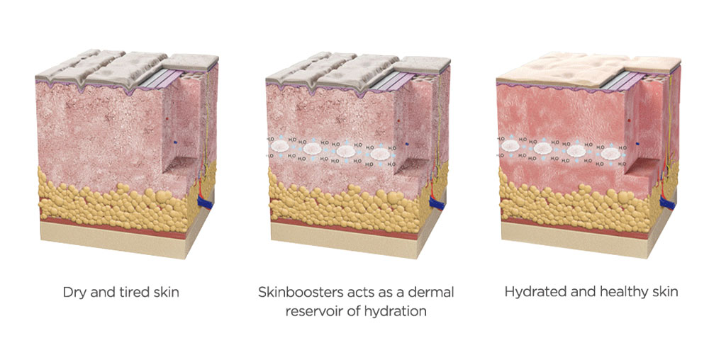trois étapes d'hydratation de la peau avec skinboosters